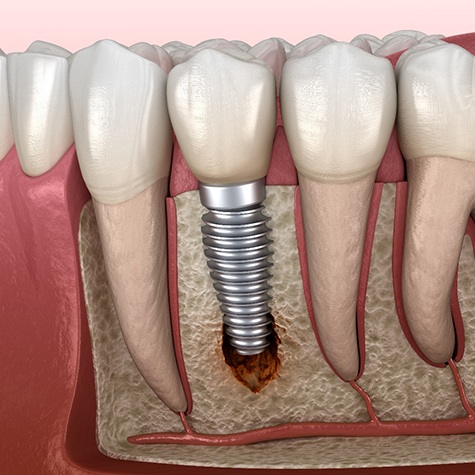 Illustration of bone loss around failed dental implant in Cinco Ranch