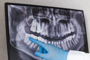 Dentist pointing to wisdom tooth