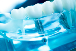 Dental implants in plastic tray with models of teeth